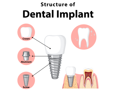 dental implants Westerville Ohio